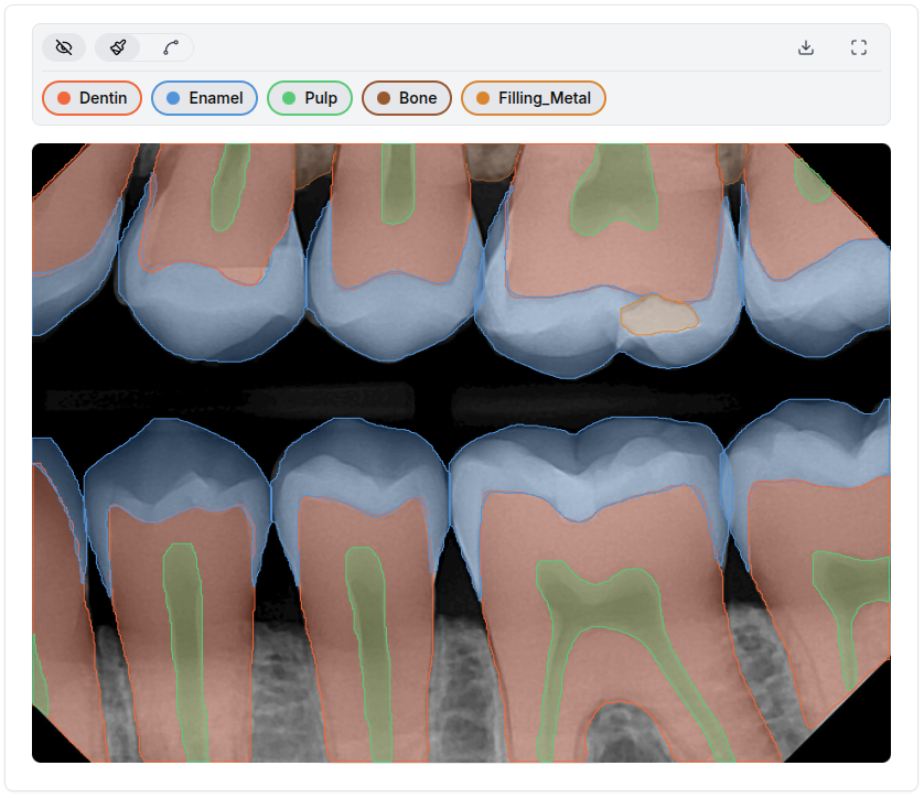DENTREAD AI segmentation process